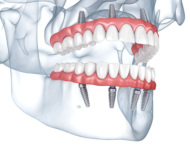 all on 4 dental implants in burnaby