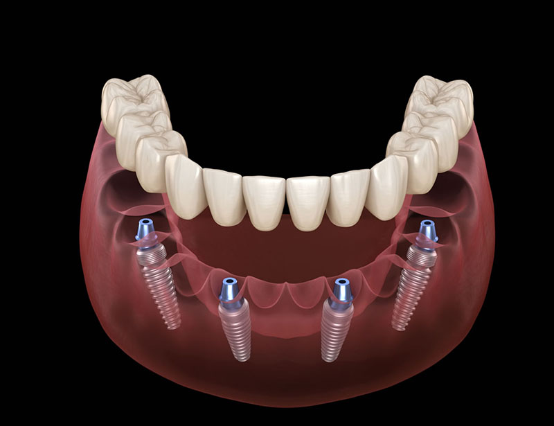 all on 4 dental implants near you